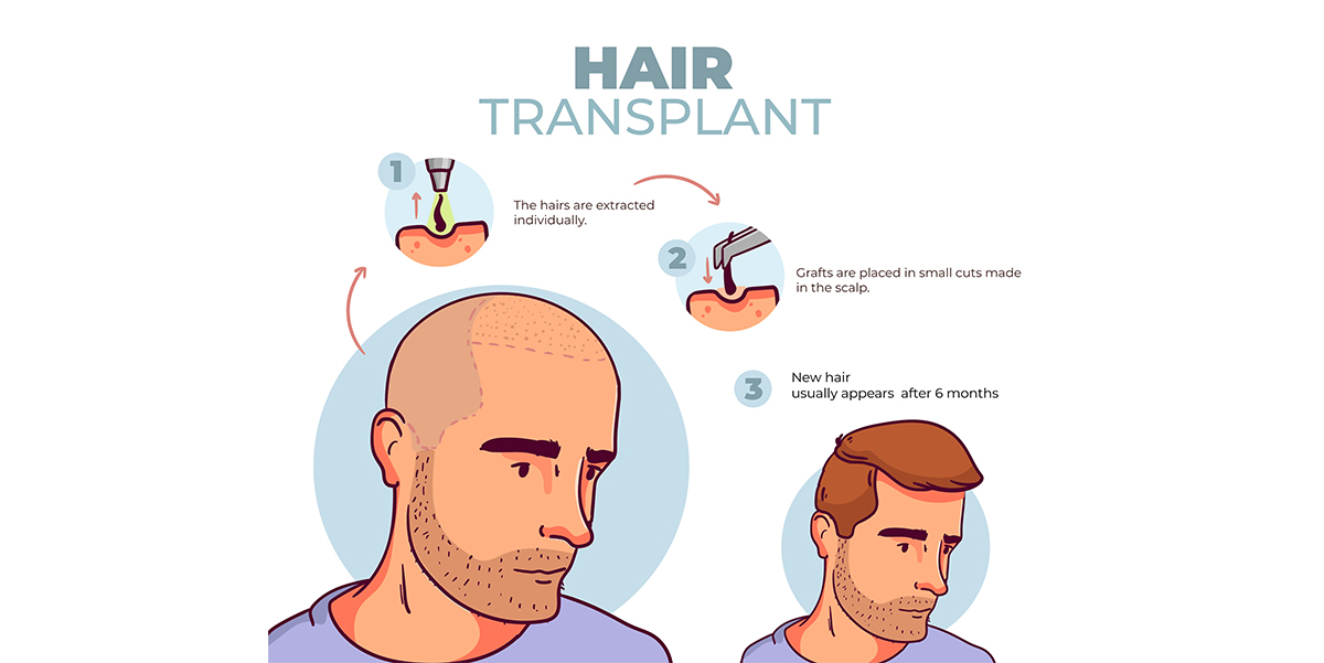 What are the Top 6 Advantages of Hair Transplant