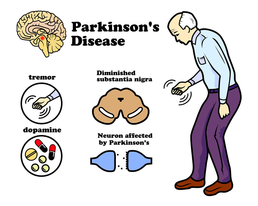 Exploring Effective Parkinson's Disease Treatments: A Comprehensive Guide - Shaper of Light