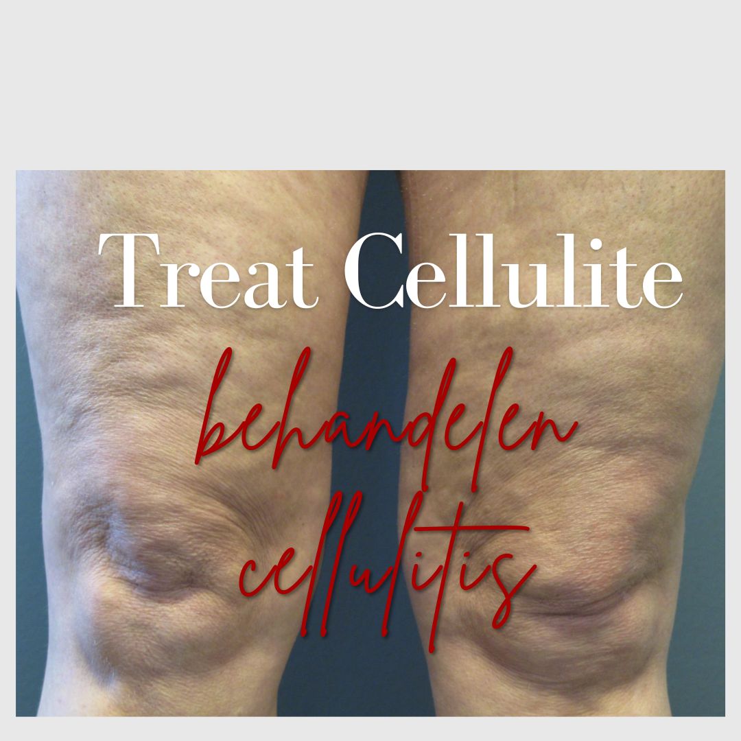 Why Cellfina Is the Most Trusted Method to treat cellulite (behandelen cellulitis)