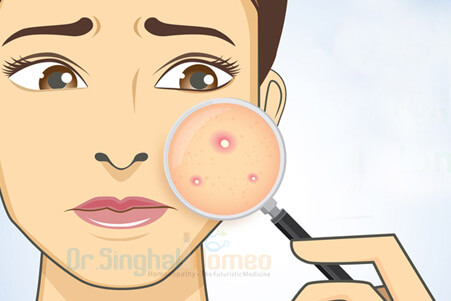 Homeopathic Medicine for Acne Scars and Pimples Treatment