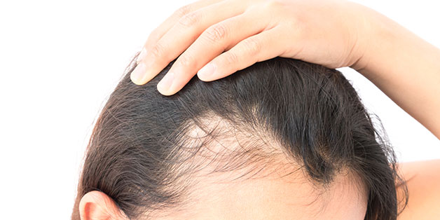 Everything One Needs To Know About FUE Hair Transplant