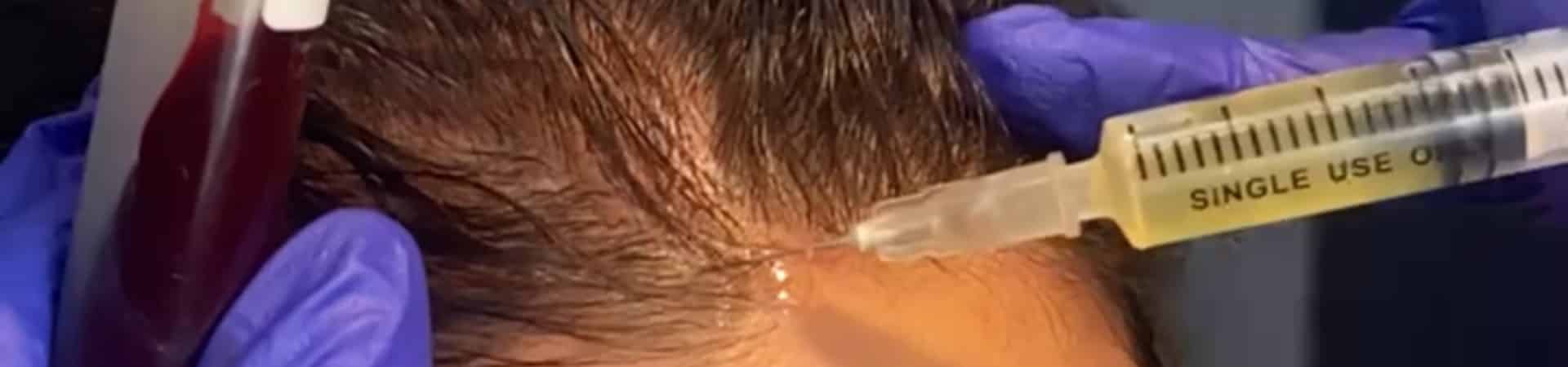 Hair Loss Blood Plasma Treatment in Cortlandt | PRP Hair Restoration Treatment - Hudson Aesthetics