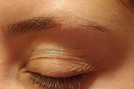 Homeopathic Medicine for Eyebrow Hair Loss Treatment in India
