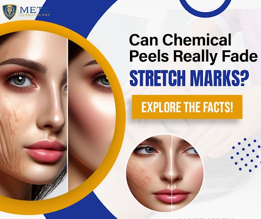 Are Chemical Peels a Good Option for Treating Stretch Marks?