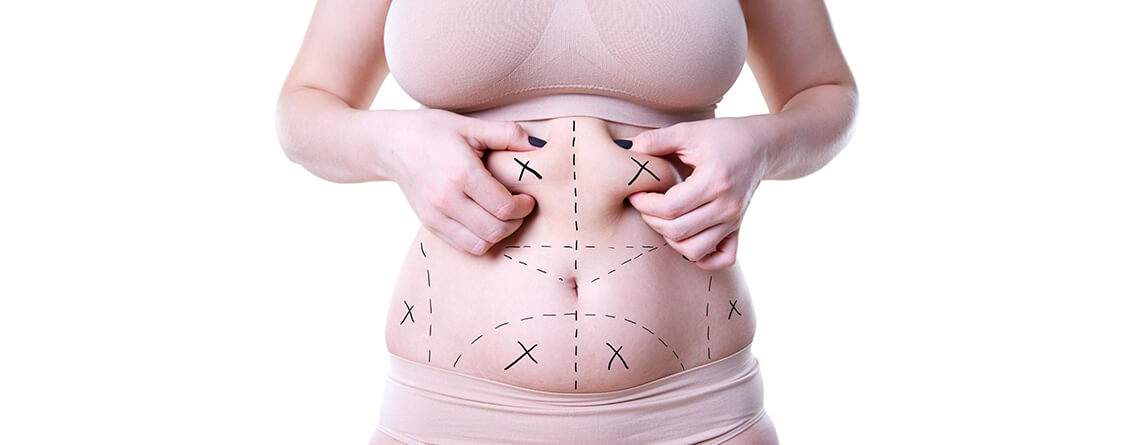 Can I Get Multiple Areas of Liposuction at Once?