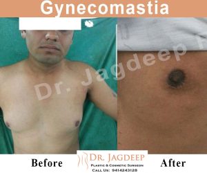 Gynecomastia Surgery in Jaipur | Gynecomastia Surgeon - Dr. Jagdeep Rao