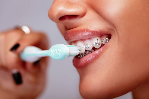 How To Brush Your Teeth with Braces | Go Ortho Smiles