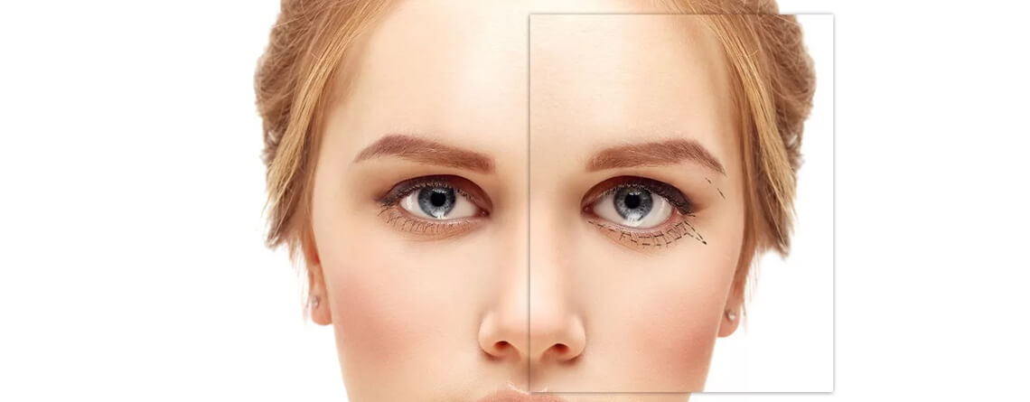 How Much Does Blepharoplasty Cost?