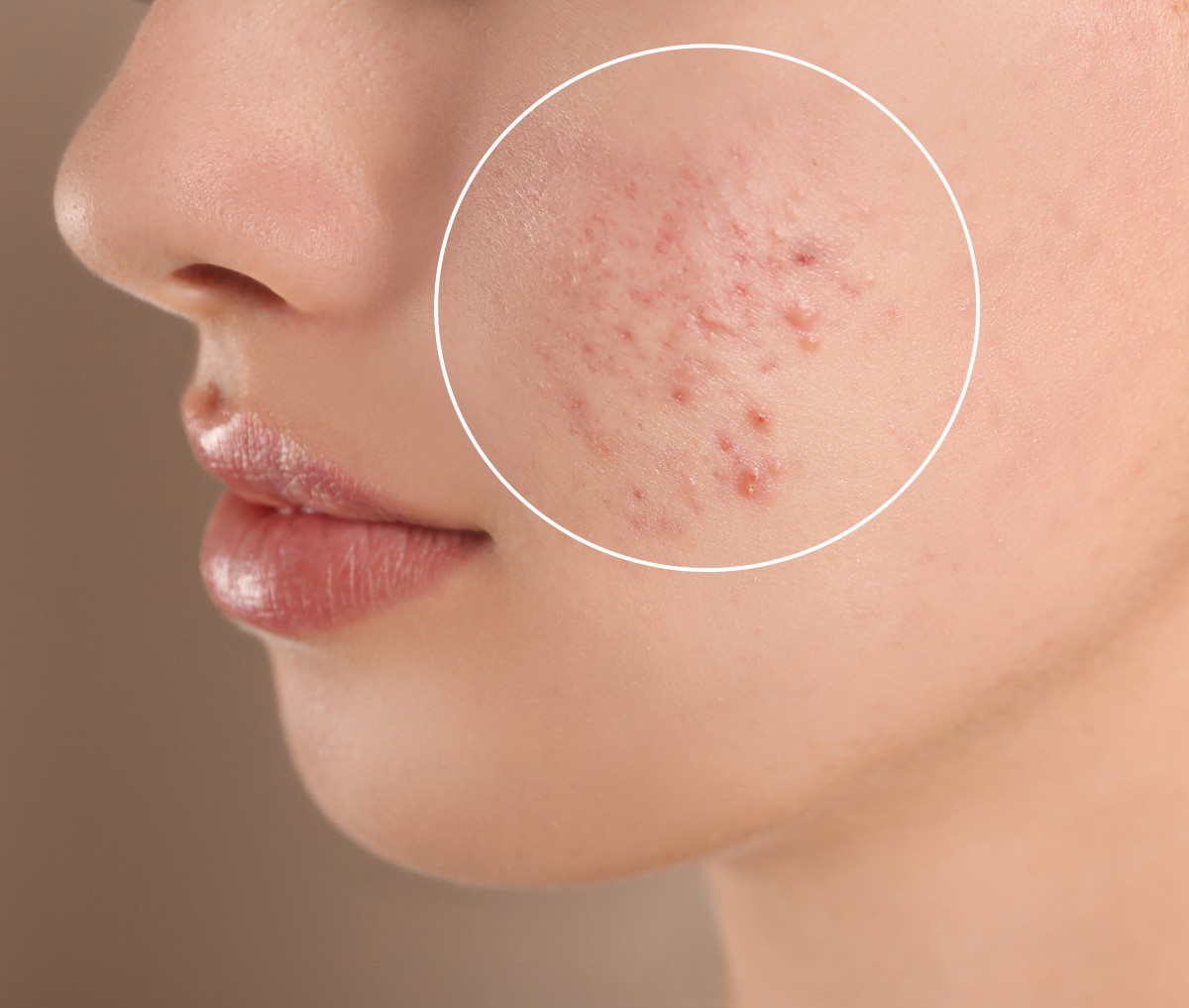 What are some of the benefits of acne scar removal treatment in Singapore? - ezine articles