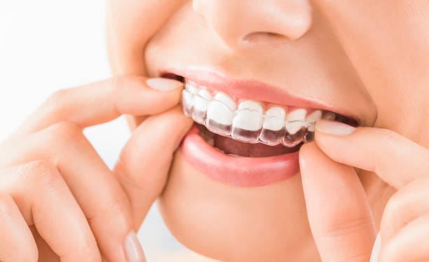 Simple Tips to Keep Your Invisalign Shinning | by Rochesterorthony | Jul, 2024 | Medium