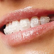 Laguna Niguel Mission Viejo, and Ladera Ranch Clear Braces