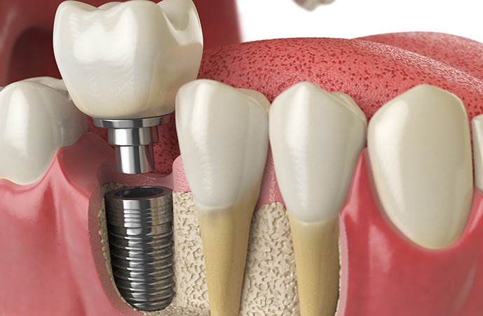 Transform Your Smile with Dental Implants in Melbourne: The Role of Oral Surgery – Creating Beautiful Natural Smiles For Life