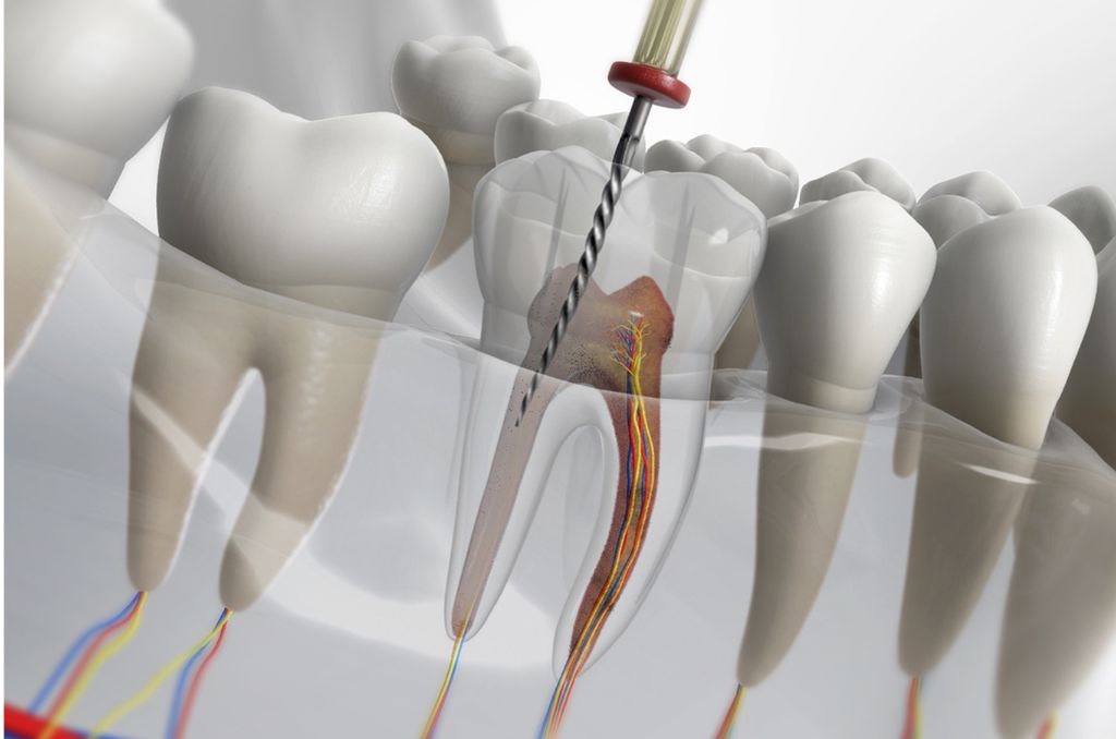 Root Canal Treatment in Borivali West - Roosh Dental Clinic