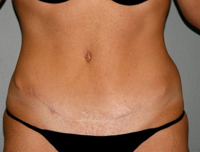 Tummy Tuck Surgery in Nashville to Look Slim and Beautiful
