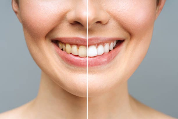Teeth Whitening — The Perks of It! | by Stannard Studt Tironi dentistry | Jul, 2024 | Medium