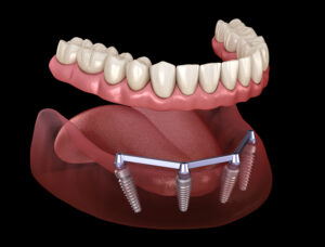 Implant specialist in Noida | Implant specialist in Noida Sector 137 | Implant specialist