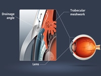 Laser Surgery for Eye Pressure - Laser Surgery for Glaucoma - Laser Treatment for Glaucoma - Laser Glaucoma Surgery