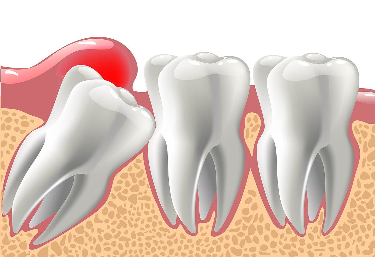 Why Choosing the Right Dentist for Wisdom Tooth Extraction in Melbourne | by Wisdom Teeth Removal | Jul, 2024 | Medium