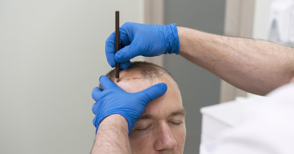 PRP: An Effective and Popular Solution for Hair Restoration in Sacramento