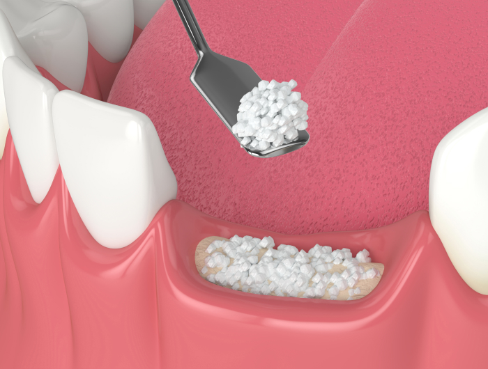 Enhance Your Smile with Expert Bone Grafting at Palm Desert Implant Dentist