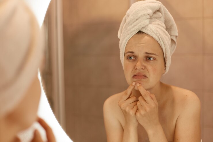 What You Should Know About Adult Acne