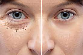 Blepharoplasty Helps Improve the Appearance of Your Eyelids - LinguaCoP
