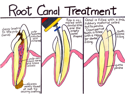 Root Canal Therapy Lewisville TX - The Colony, Texas Root Canal Therapy - D. Dental