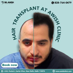 FUE Hair Transplant Clinic in Delhi NCR | Natural Hair Restoration - AWISH CLINIC