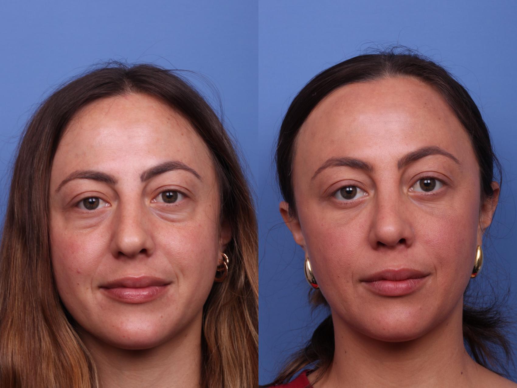 Understanding Blepharoplasty & Its 3 Stages - Internet Chicks