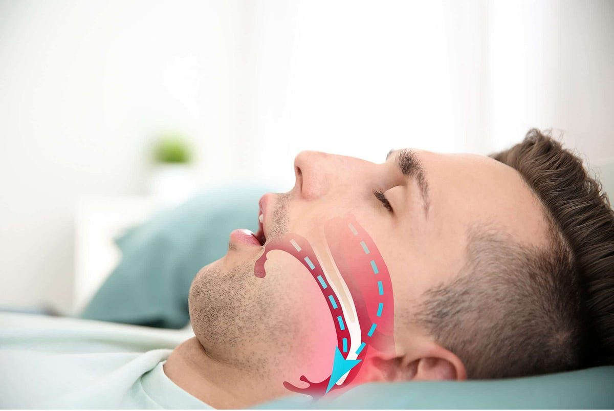 How Your Dentist Can Tell If You Might Have Sleep Apnea | by My Smilebody | Medium