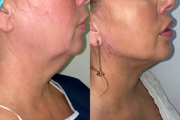 Lipolaser voor onderkin: de niet-chirurgische oplossing die u nodig hebt – Medica Estatica