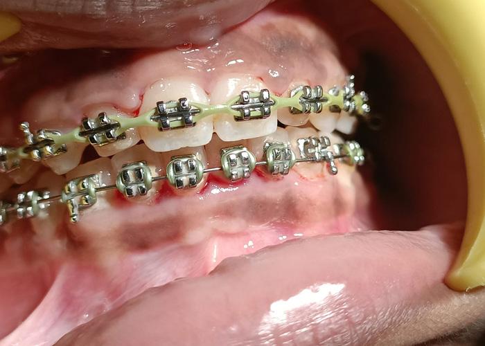 Best Orthodontist in Coimbatore | Teeth Straightening