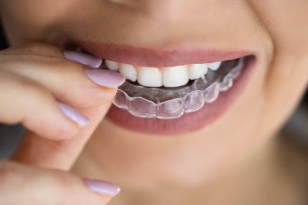 Eating Tips to Follow While Wearing Invisalign