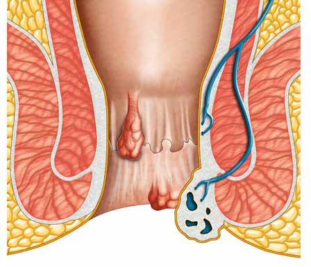 Fistula Treatment in Dubai | Anal Fistula treatment UAE