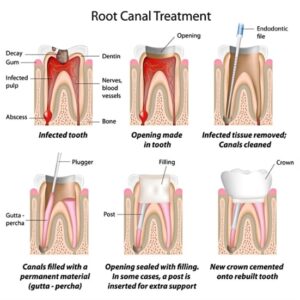 RCT Specialist in Noida Sector 76 | Root Canal Treatment Specialist in Noida | RCT Specialist in Noida