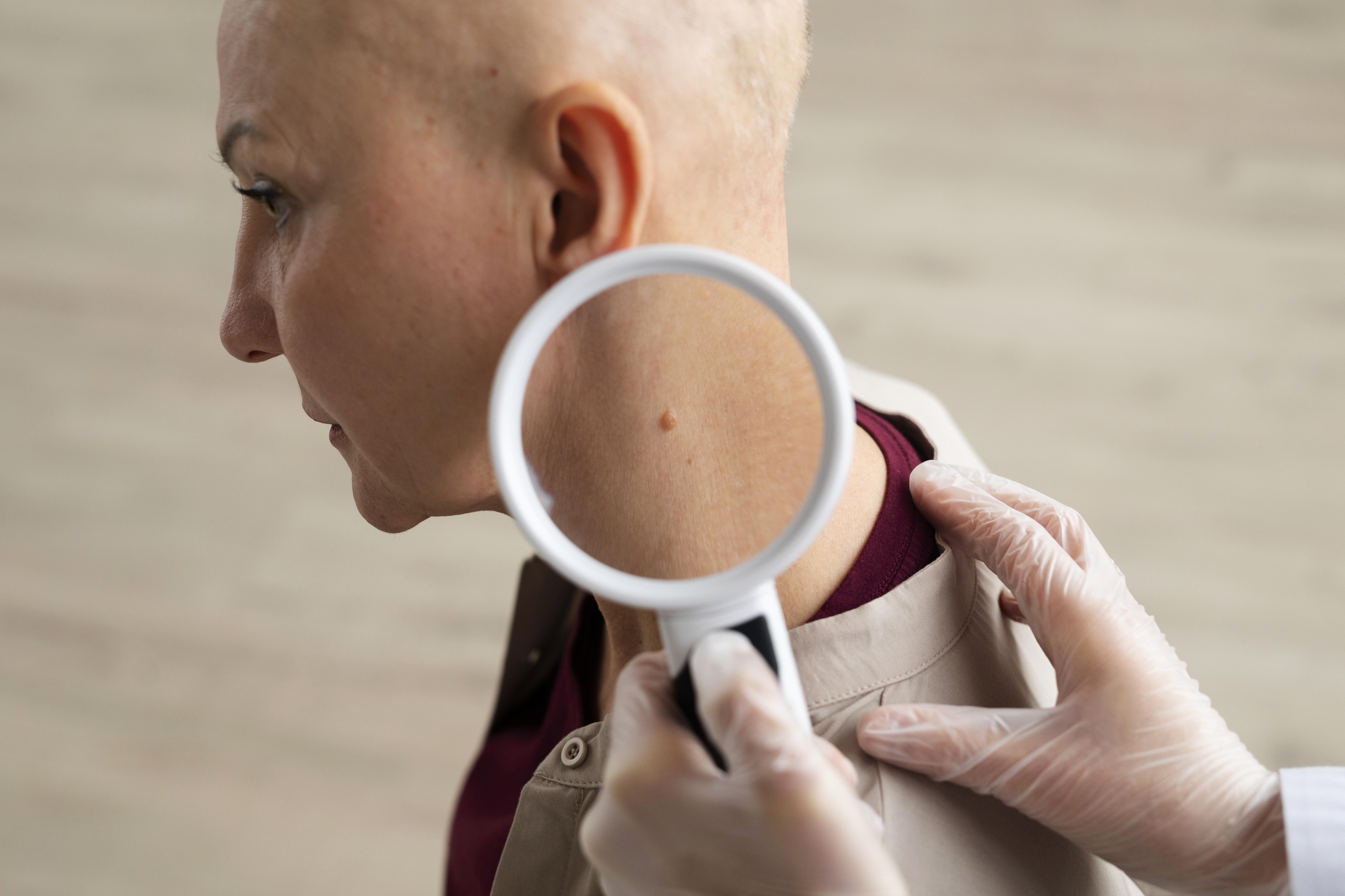 Skin Cancer | Fortis Healthcare