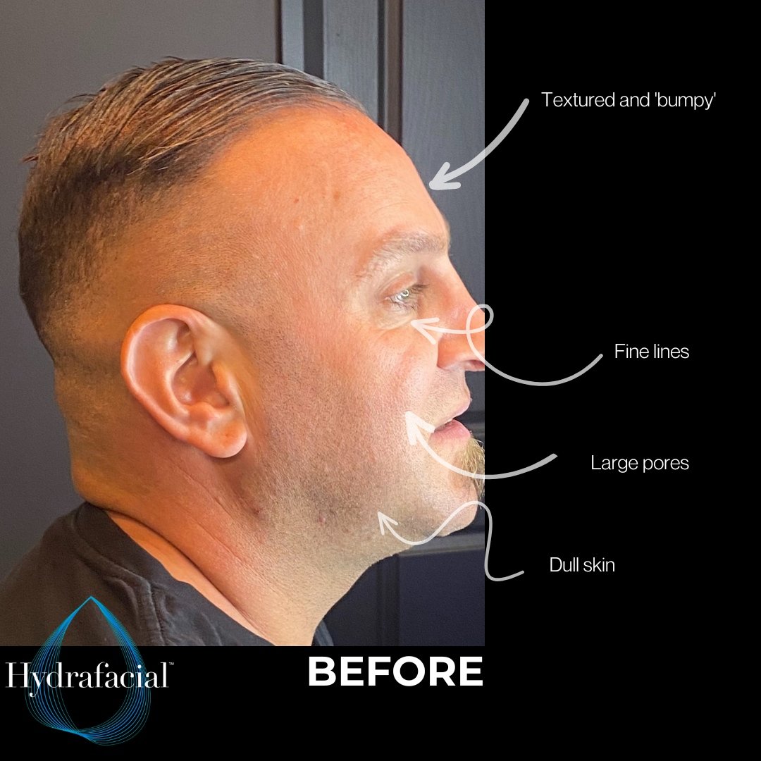 What Makes Hydrafacial One Of The Best Men's Facial Sydney Treatment Solutions? | FACTOFIT