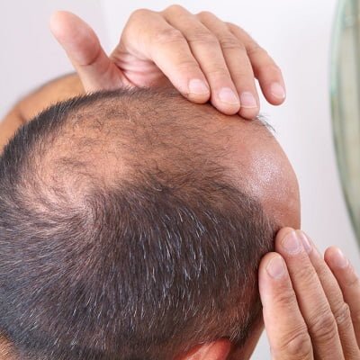 Hair Loss Treatment in Islamabad, Rawalpindi & Pakistan | SKN Cosmetic