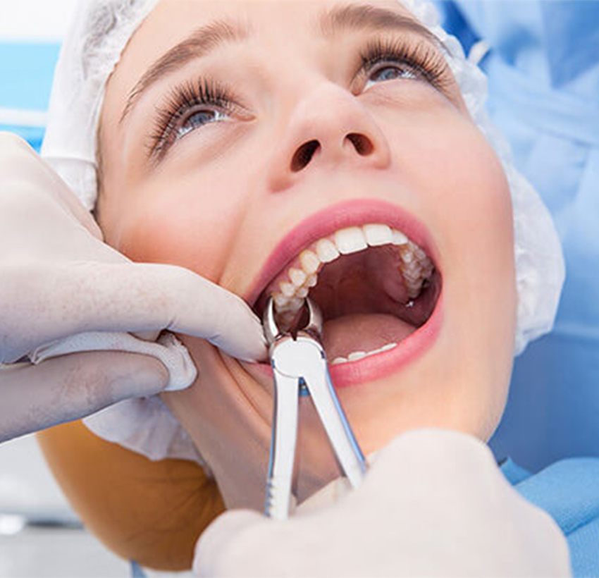 Dental Extraction Near Me in Al Ain | Tooth Extraction Clinic