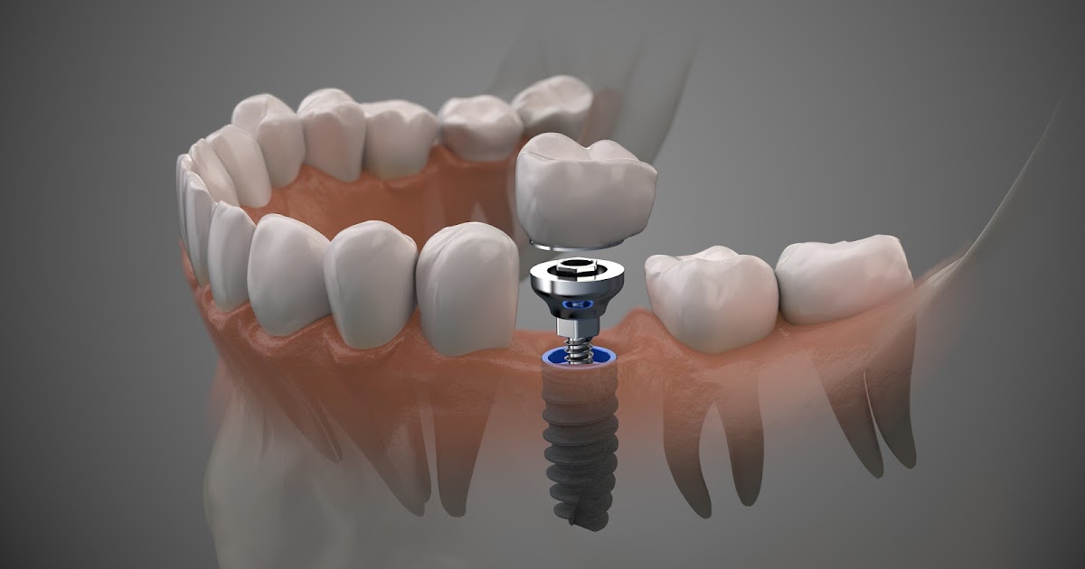 Everything You Need to Know About Single Tooth Implants