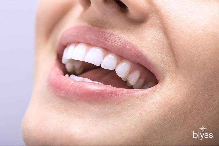 How Long Does Professional Teeth Whitening Last?