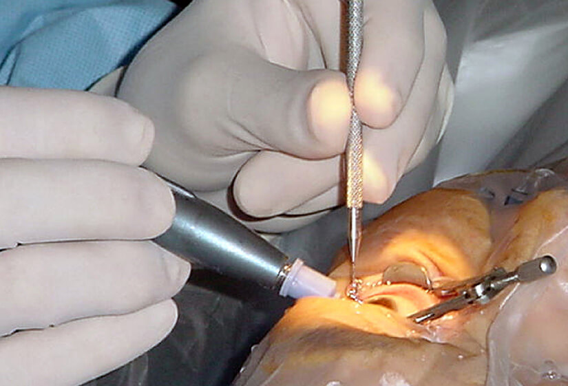 How Long Does Cataract Surgery Last?