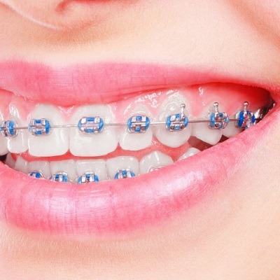 Cheapest Dental Braces Cost in Dubai&Abu Dhabi | Price's