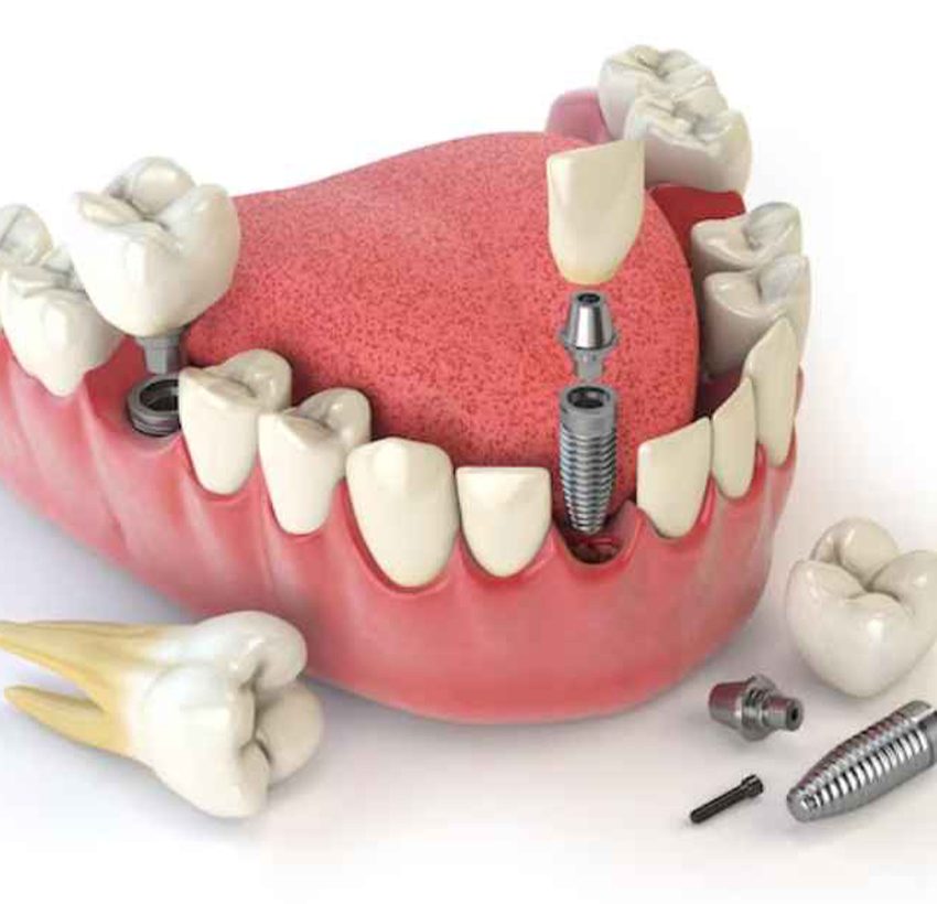 Dental Implants In Al Ain | Best Dental Implants UAE
