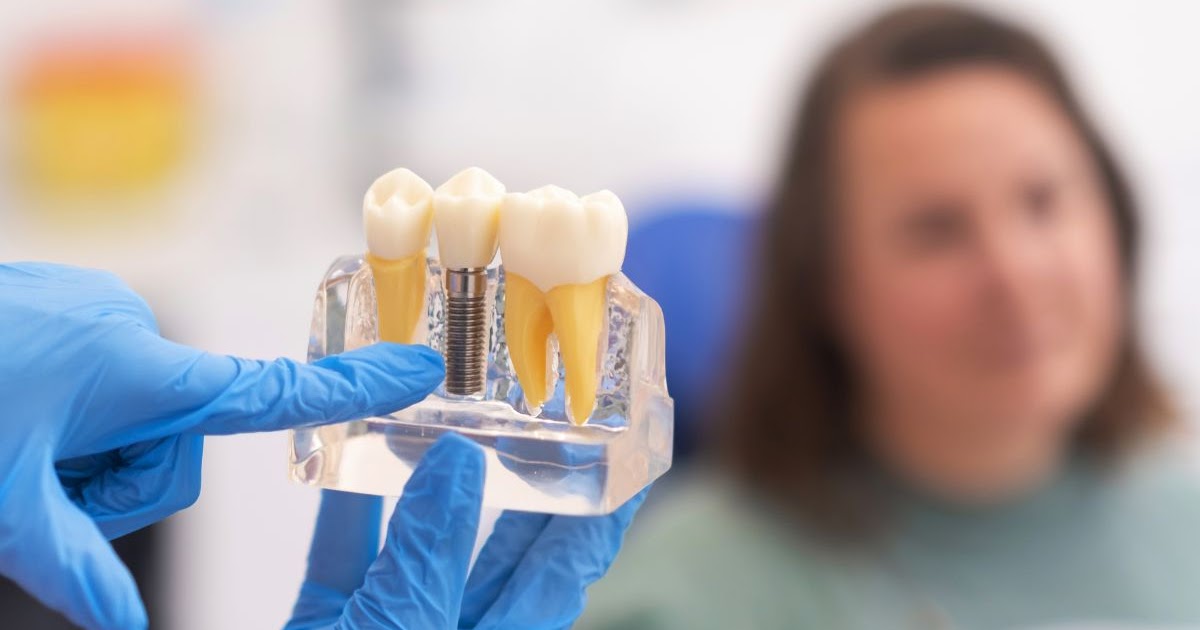 Exploring the Different Types of Dental Implants