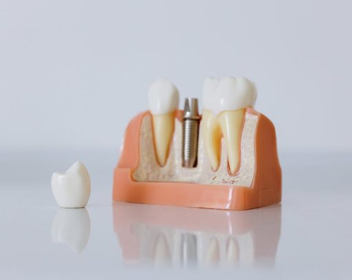 Dental Implants in Irvine, CA | Transform Your Smile Today