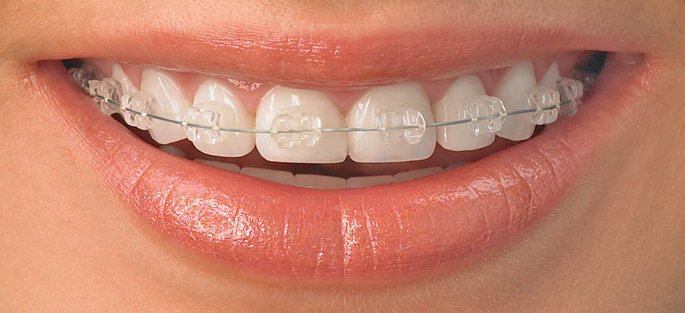 Braces in Nagpur | Teeth Straightening in Nagpur