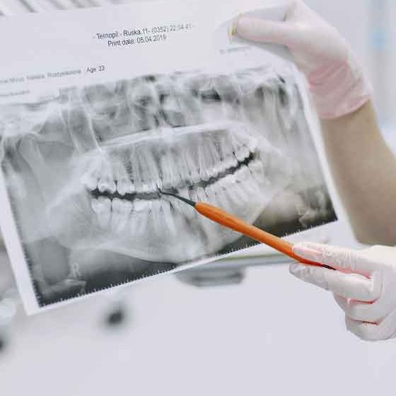 Quality Dental Crown in Irvine| Restore Your Smile