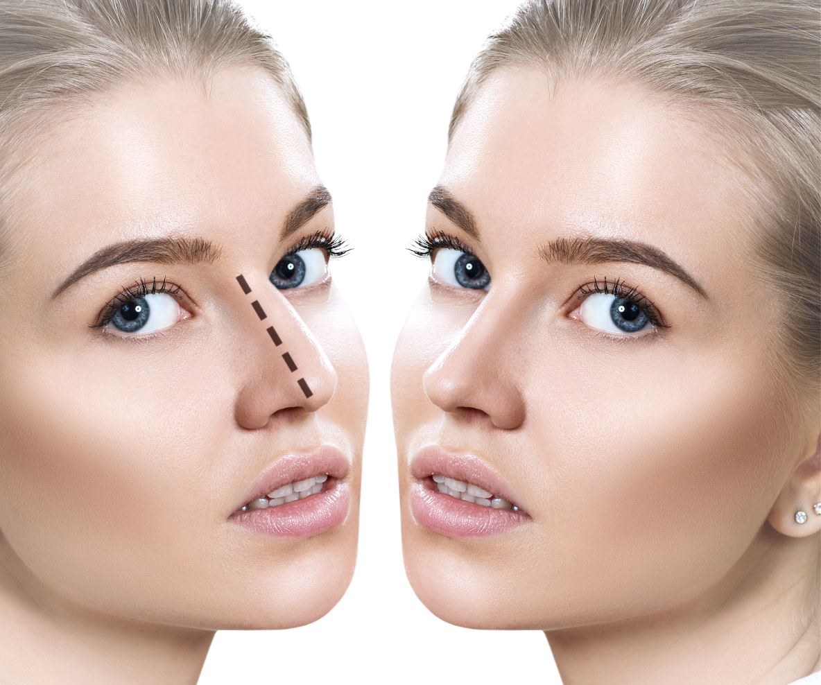 Rhinoplasty - Nose Correction | EDEN AESTHETICS