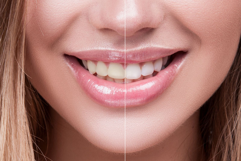 Teeth Whitening Dentist Seminole, FL | NuSmile Dental